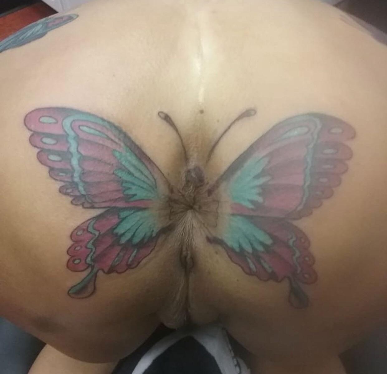 Anal butterfly
